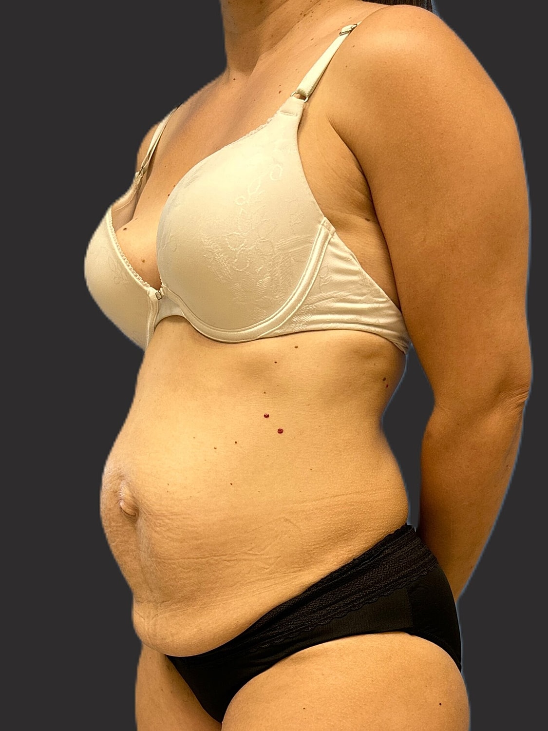 Tummy Tuck Before & After