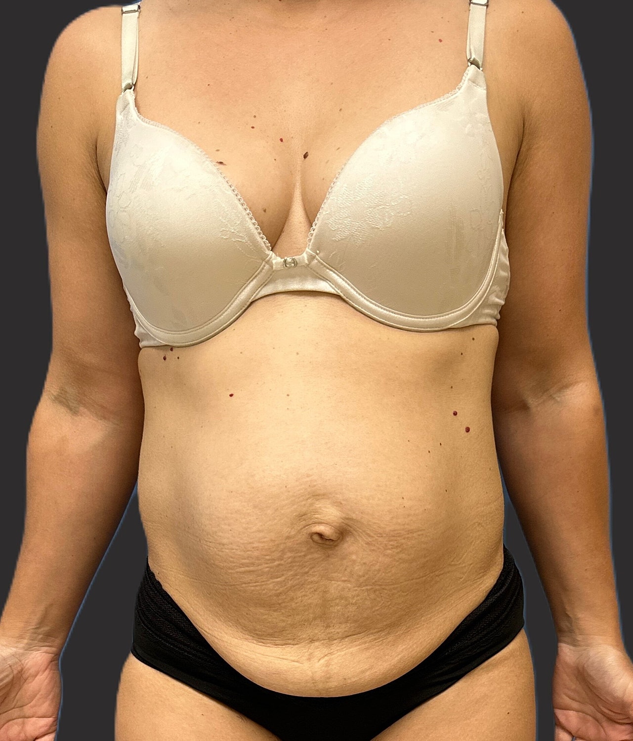 Tummy Tuck Before & After