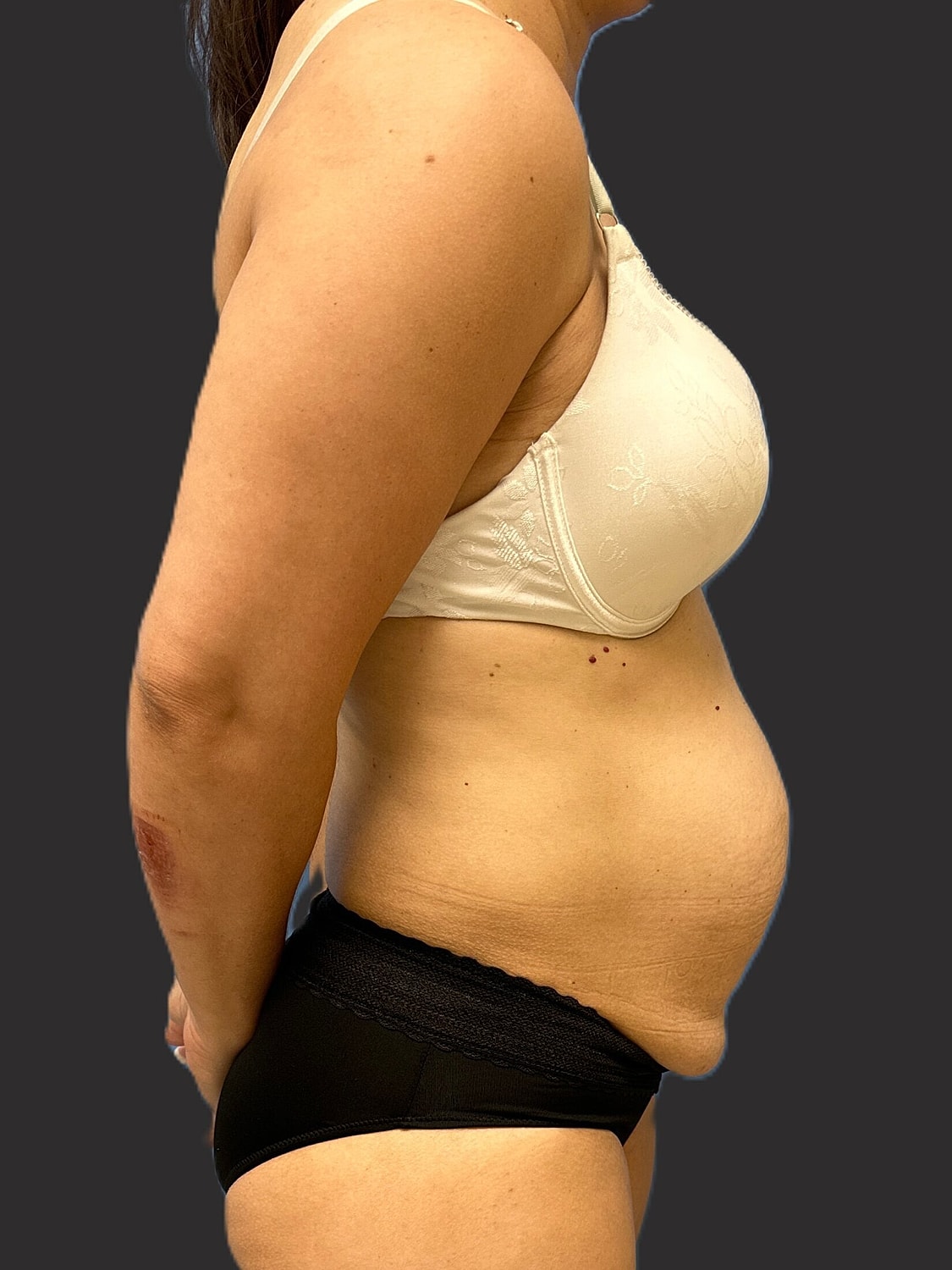 Tummy Tuck Before & After
