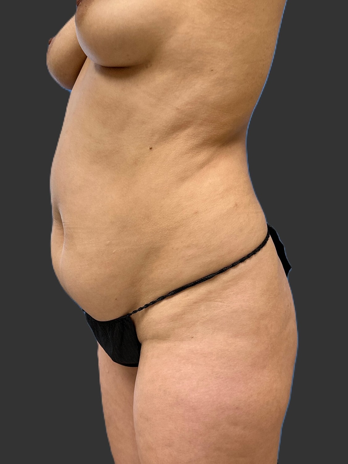 Tummy Tuck Before & After