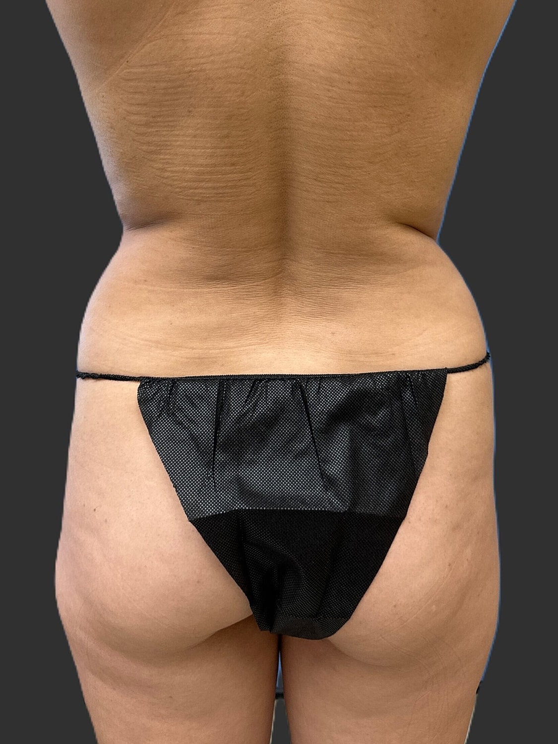 Tummy Tuck Before & After