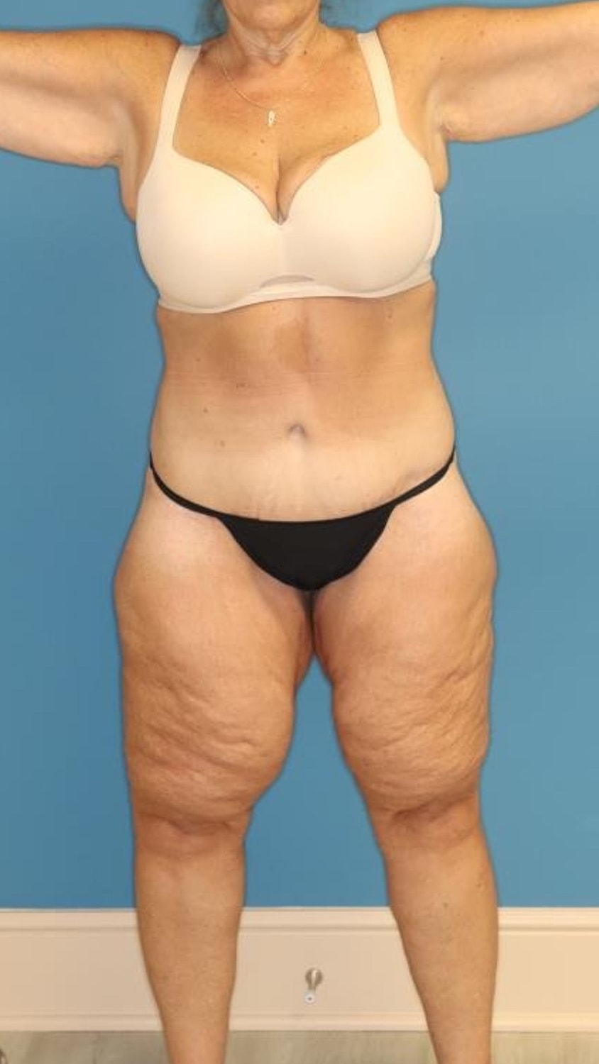 Tummy Tuck Before & After