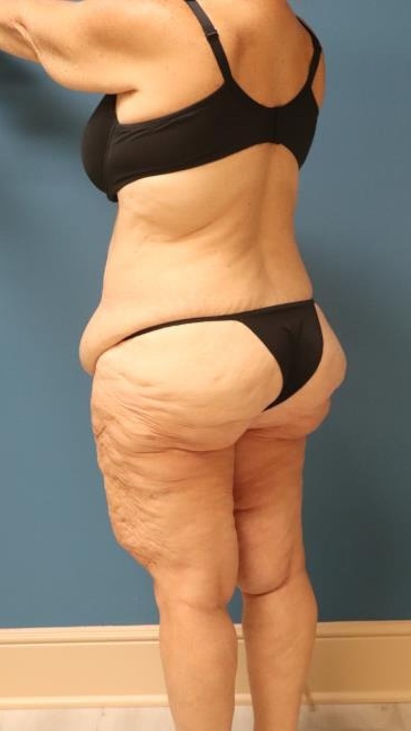 Tummy Tuck Before & After