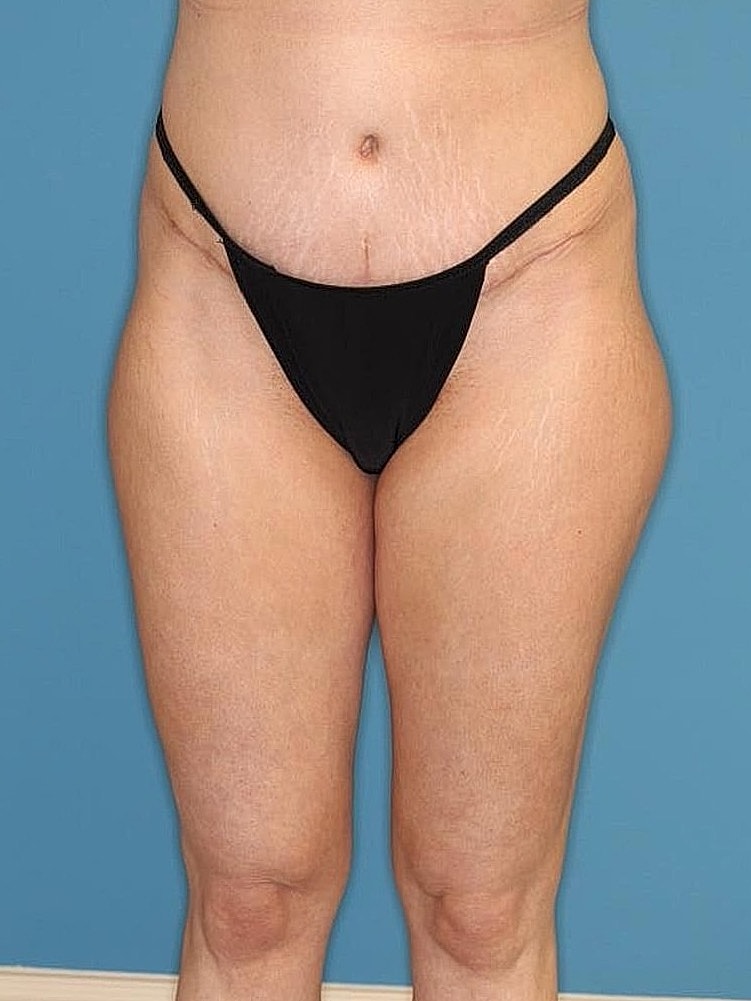 Tummy Tuck Before & After