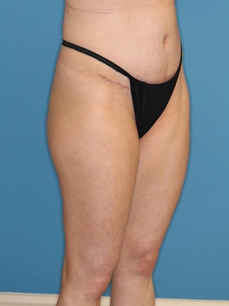 Tummy Tuck Before & After