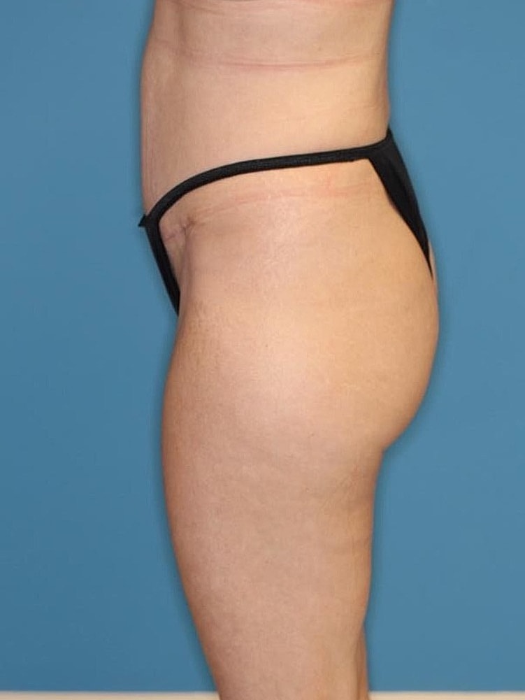 Tummy Tuck Before & After