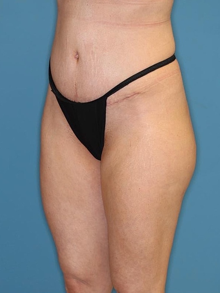 Tummy Tuck Before & After