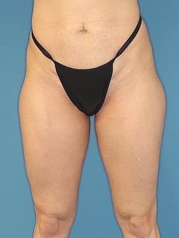 Tummy Tuck Before & After