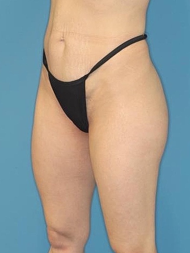 Tummy Tuck Before & After