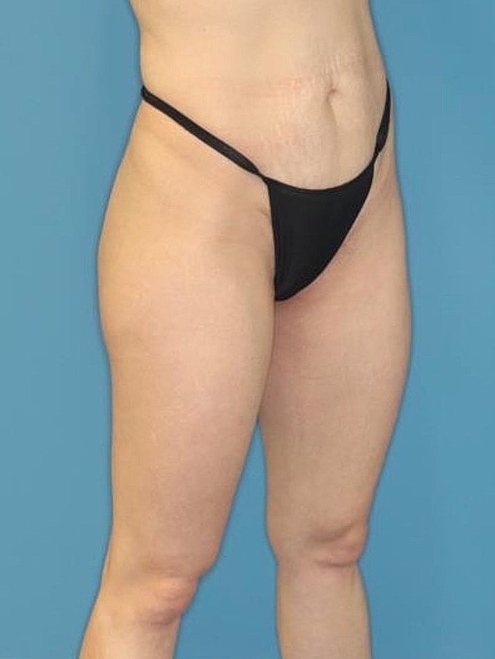 Tummy Tuck Before & After