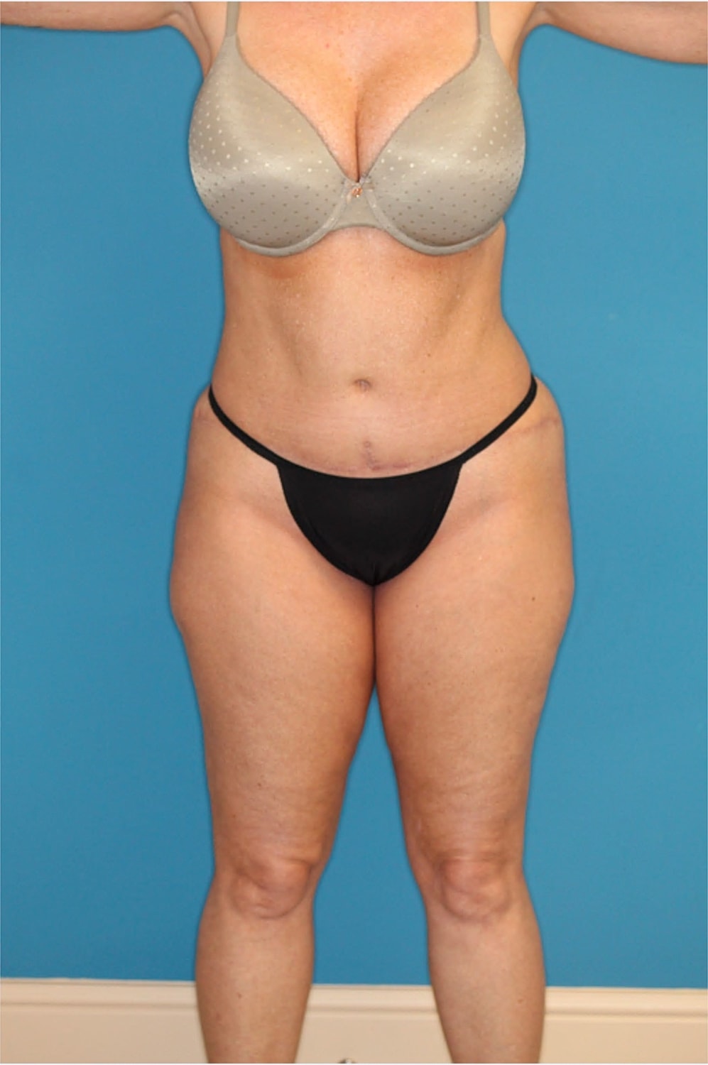 Tummy Tuck Before & After