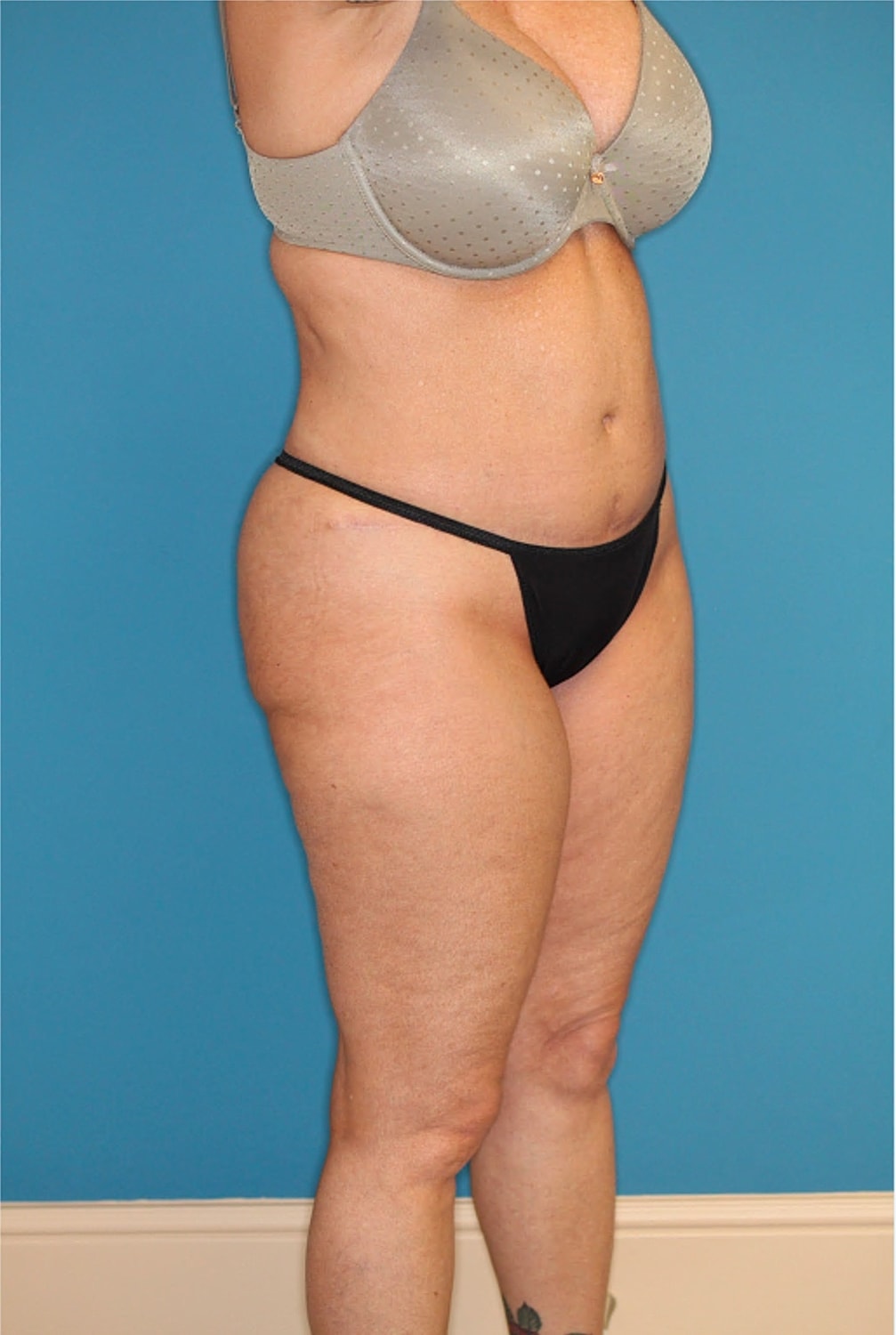Tummy Tuck Before & After
