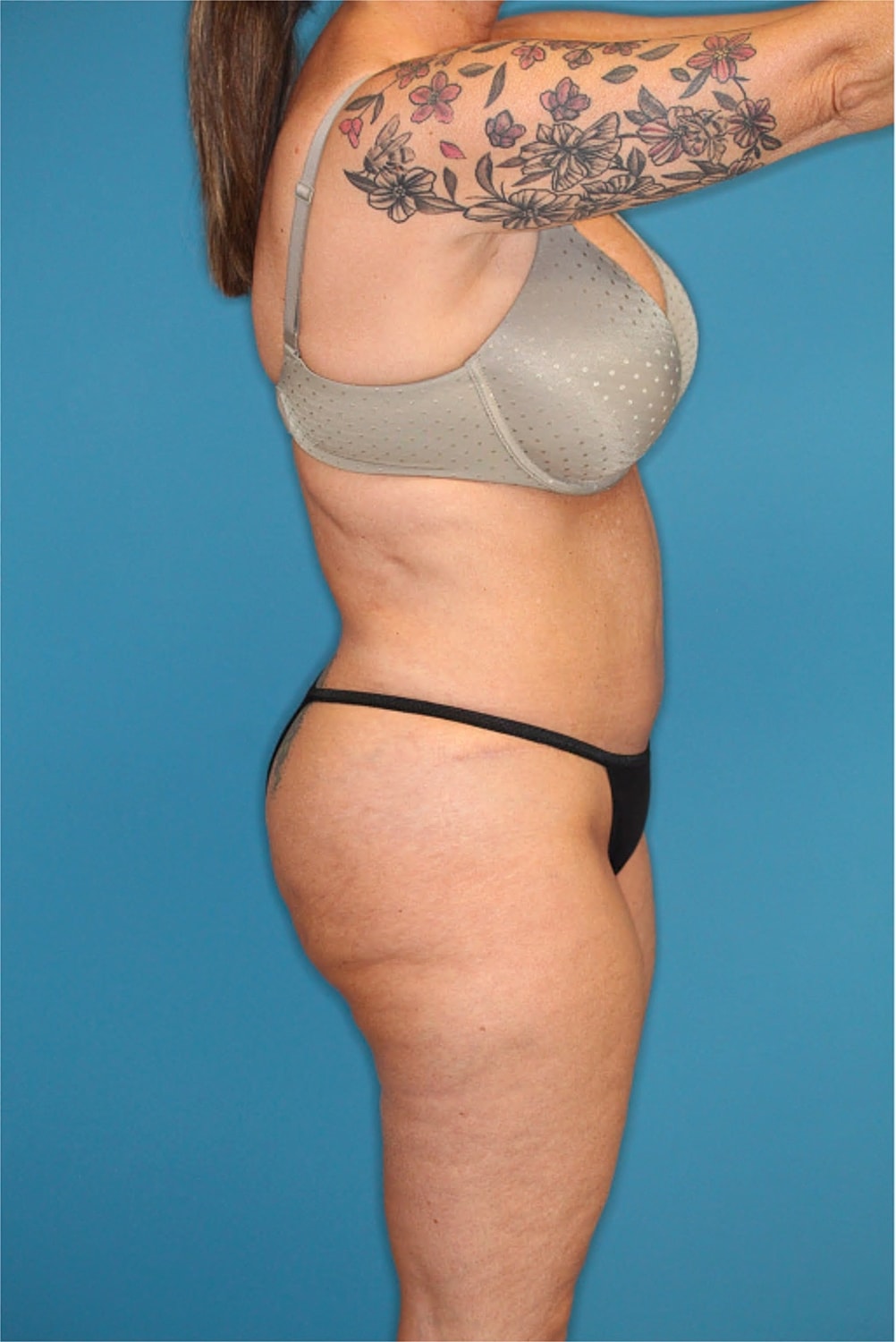 Tummy Tuck Before & After