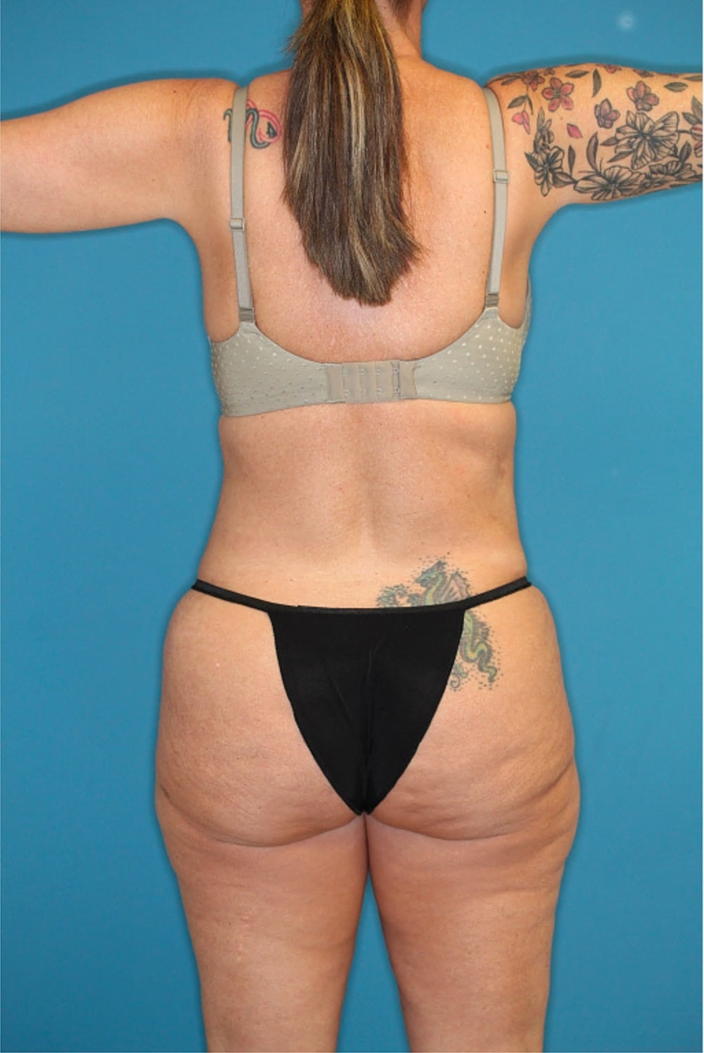Tummy Tuck Before & After
