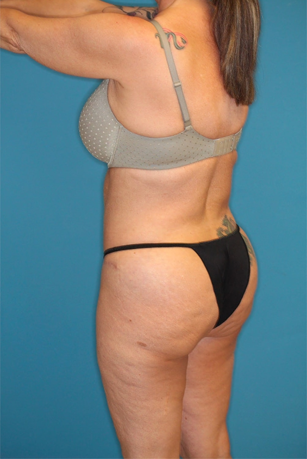 Tummy Tuck Before & After
