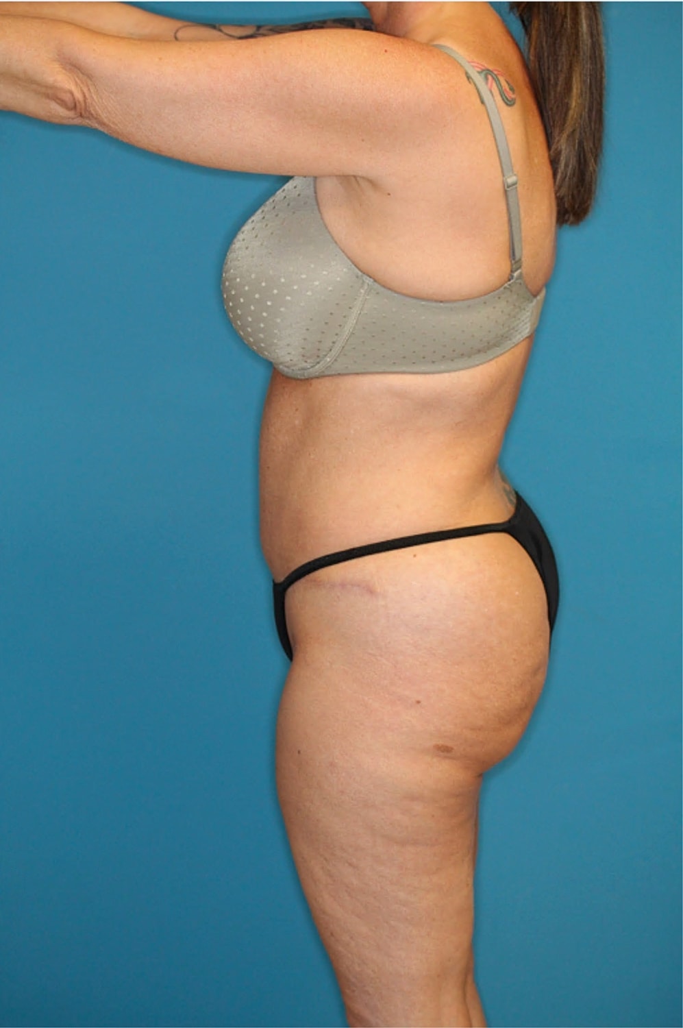 Tummy Tuck Before & After