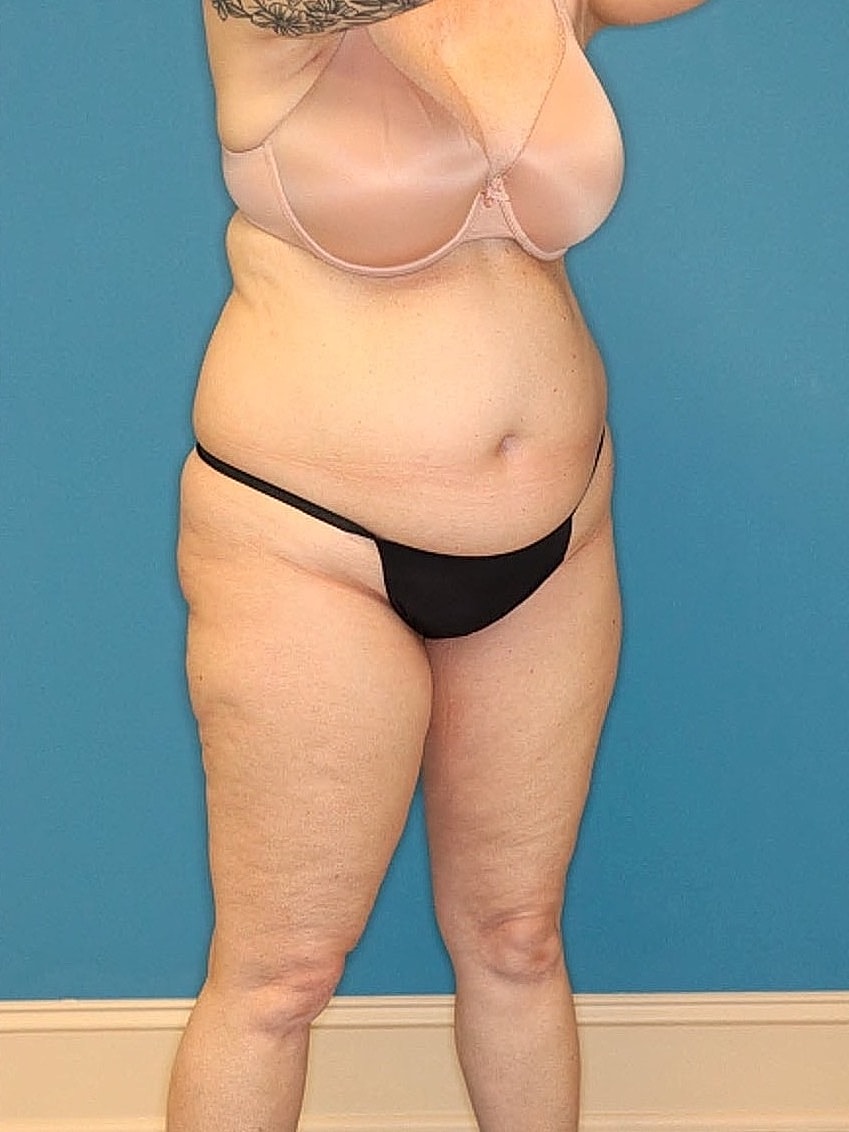 Tummy Tuck Before & After