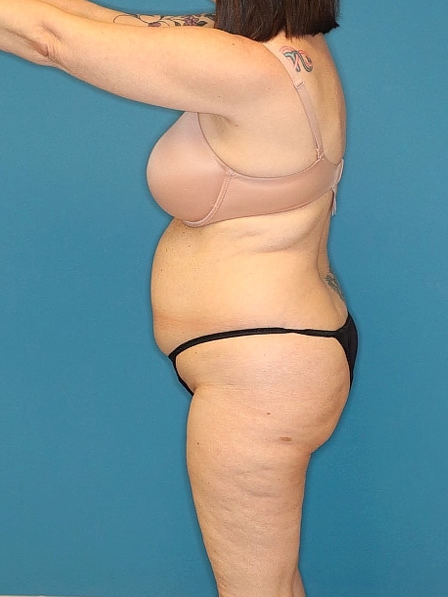 Tummy Tuck Before & After
