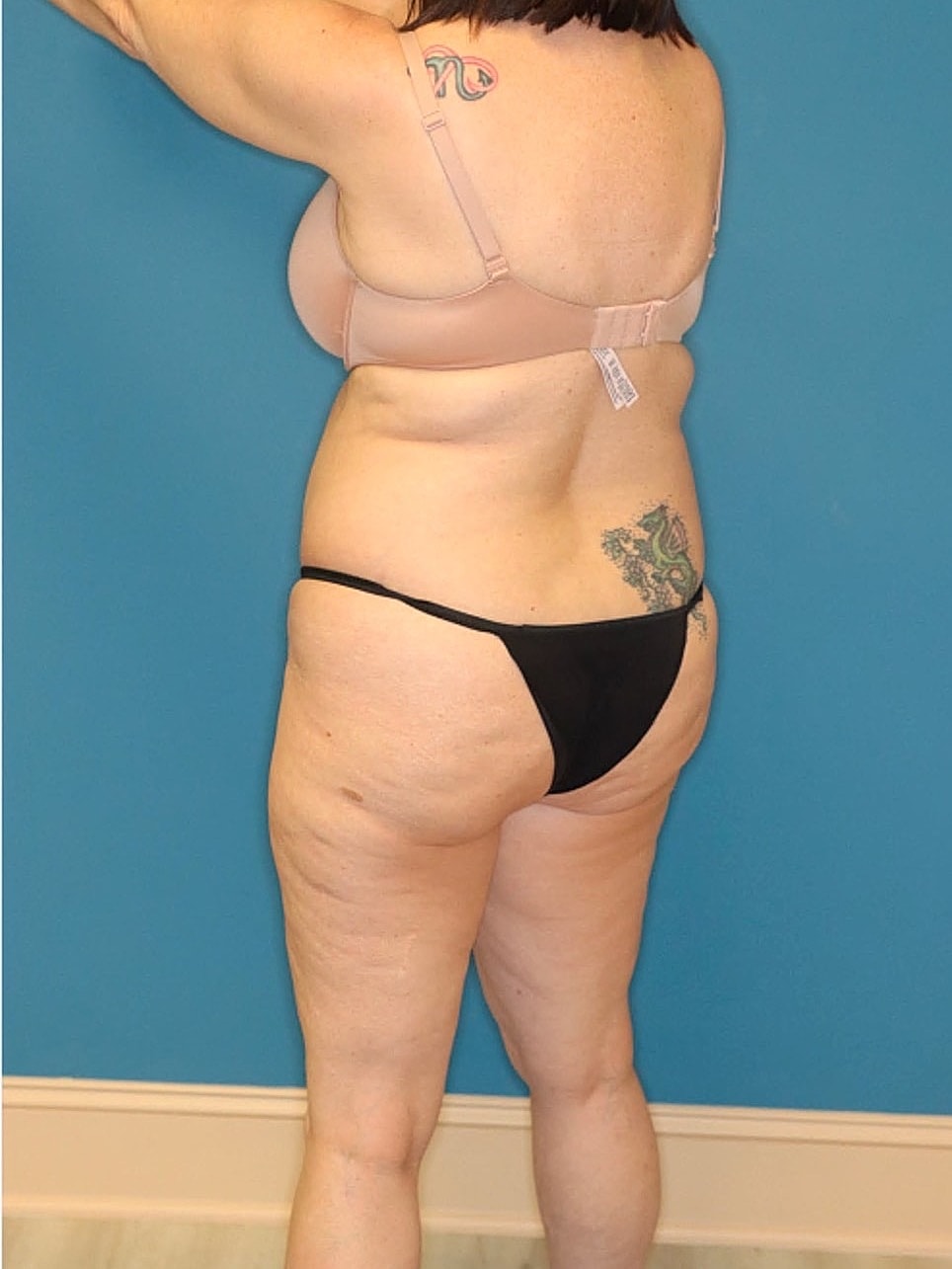 Tummy Tuck Before & After