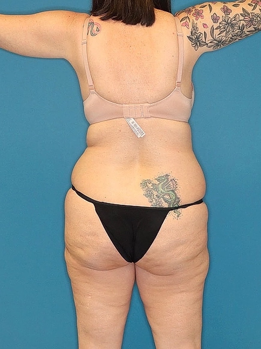 Tummy Tuck Before & After