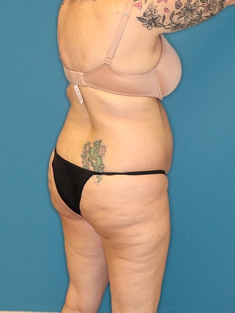 Tummy Tuck Before & After