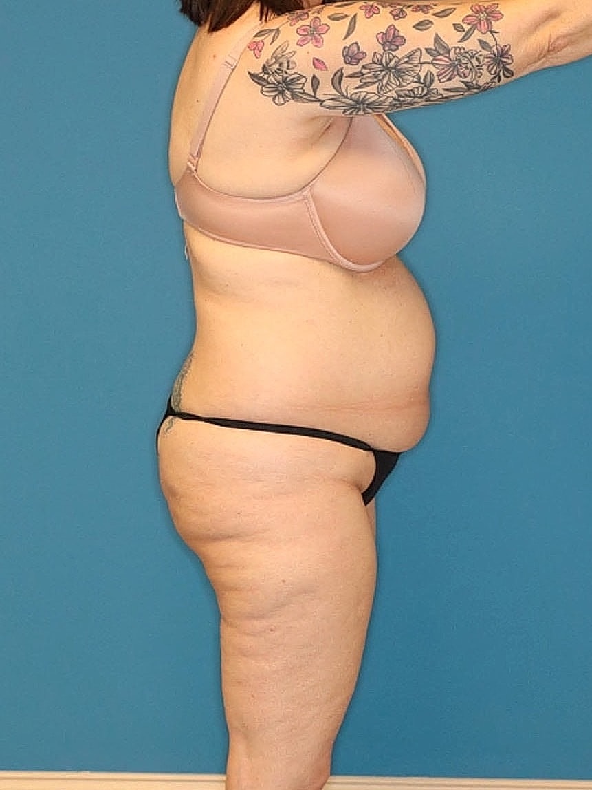Tummy Tuck Before & After