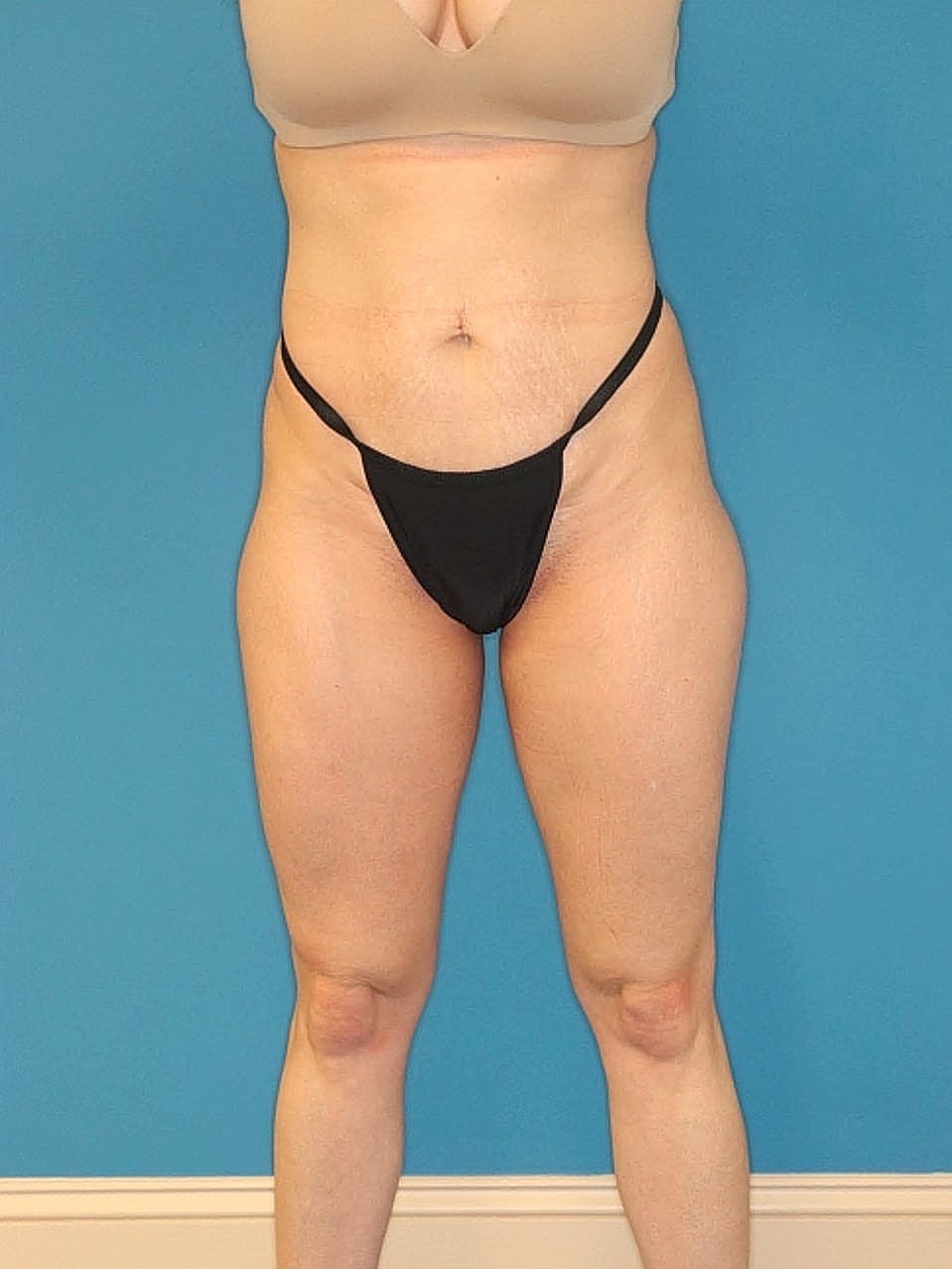 Tummy Tuck Before & After