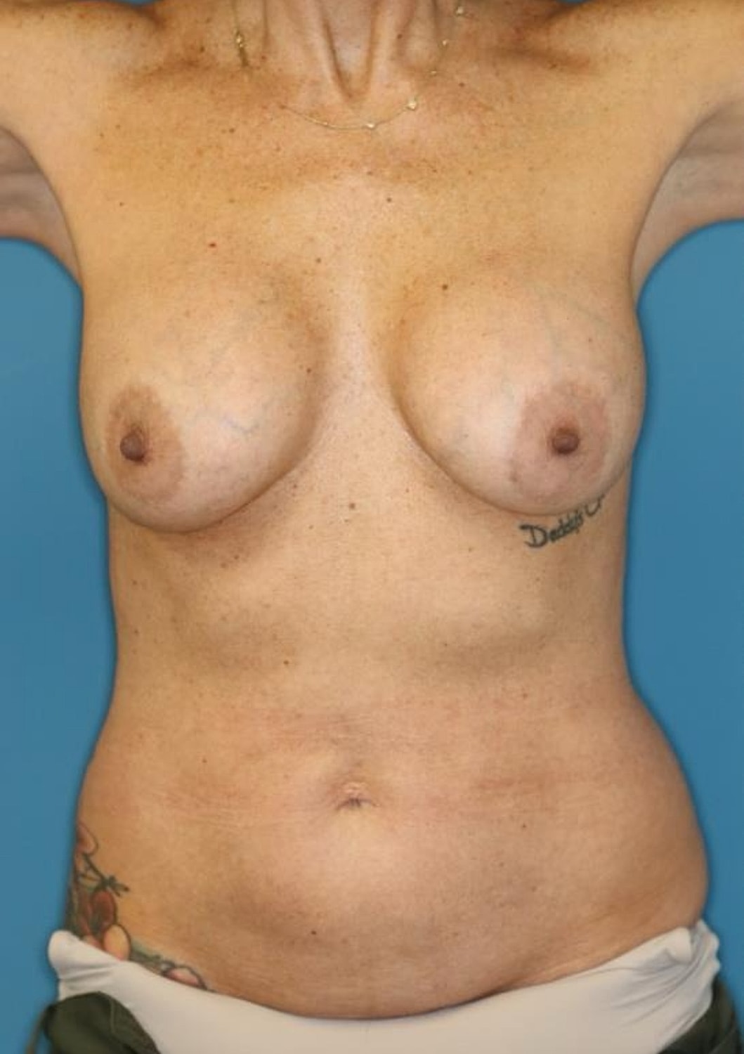 Tummy Tuck Before & After