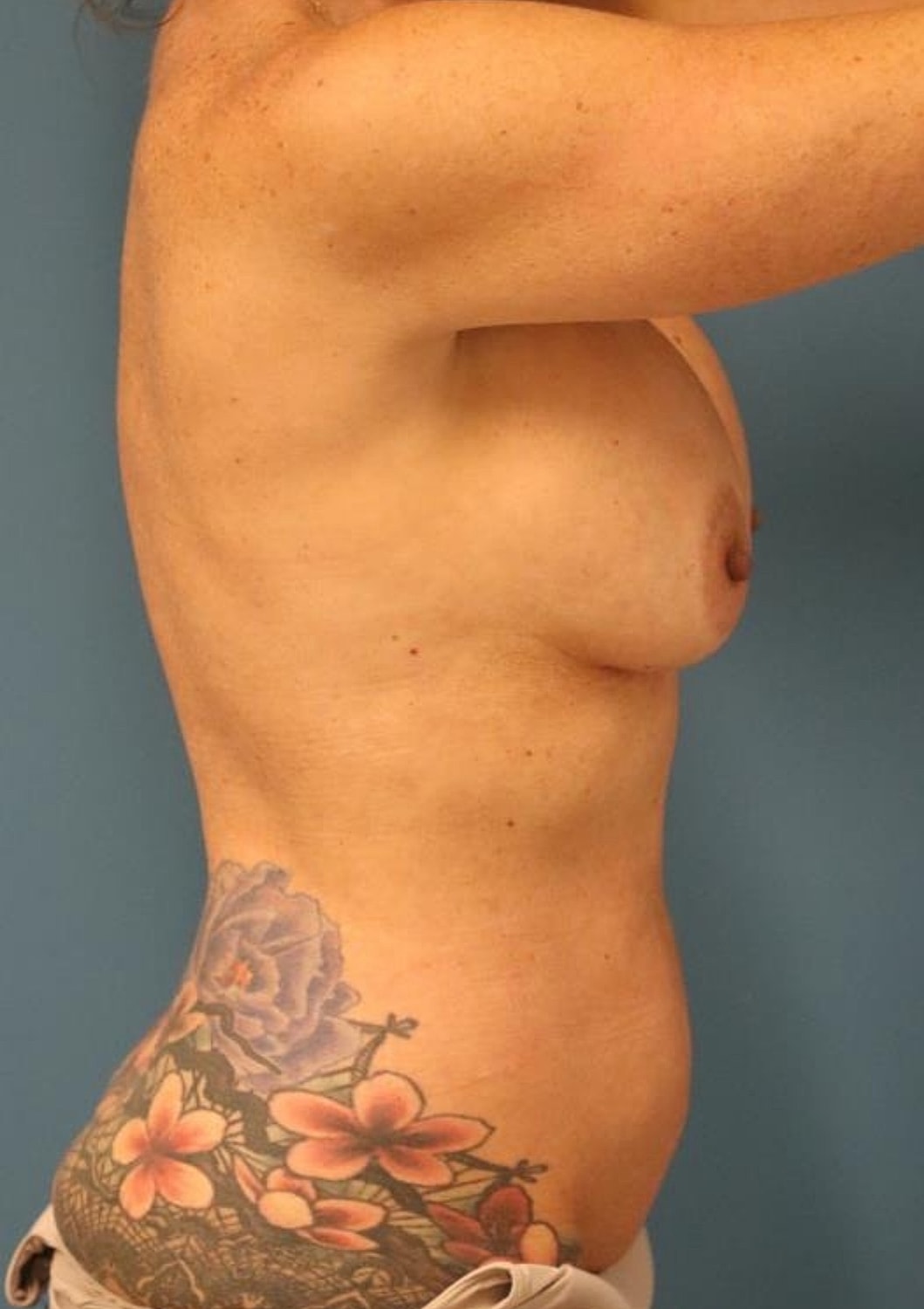 Tummy Tuck Before & After