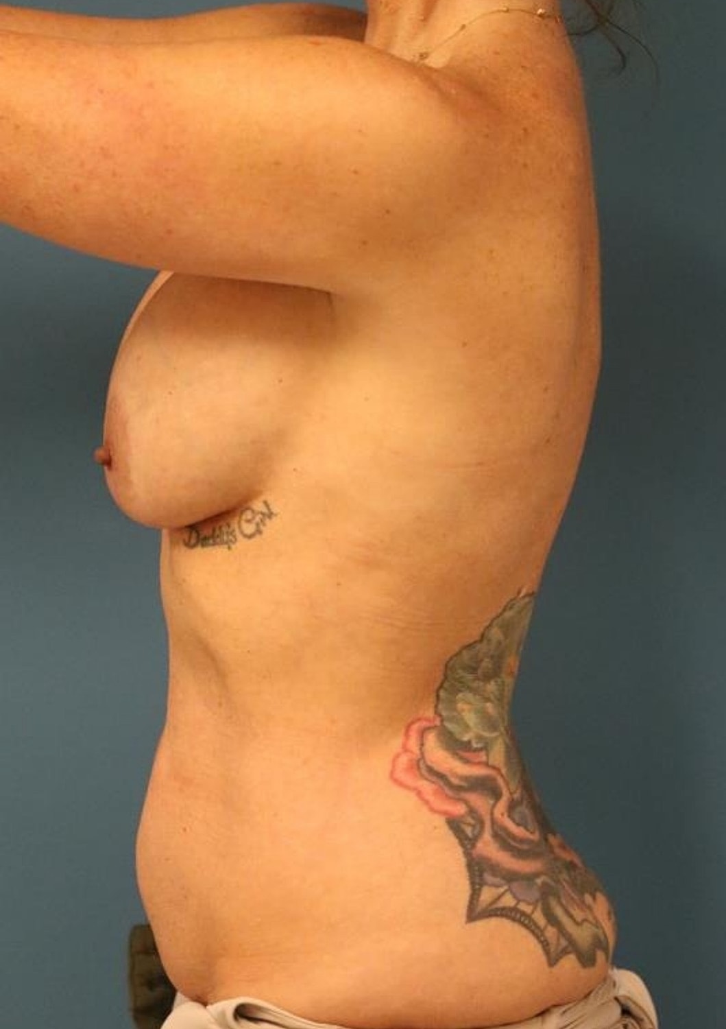 Tummy Tuck Before & After
