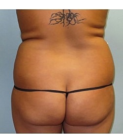 Brazilian Butt Lift Before & After
