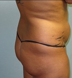 Brazilian Butt Lift Before & After