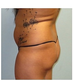 Brazilian Butt Lift Before & After