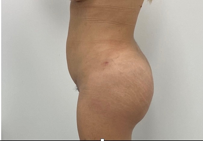 Brazilian Butt Lift Before & After
