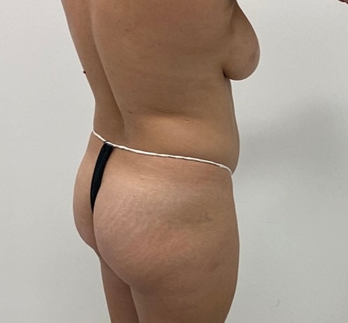 Brazilian Butt Lift Before & After