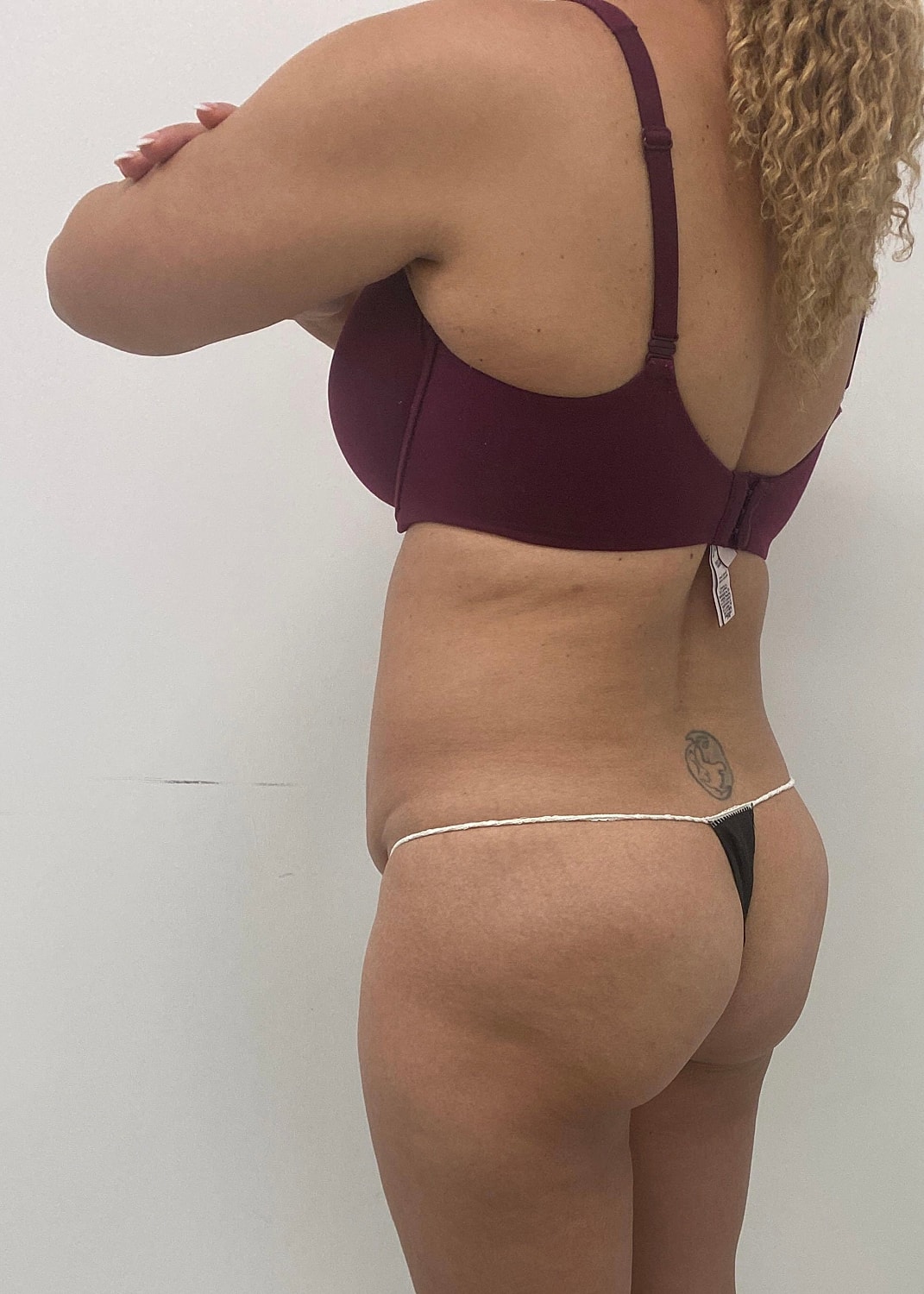 Brazilian Butt Lift Before & After