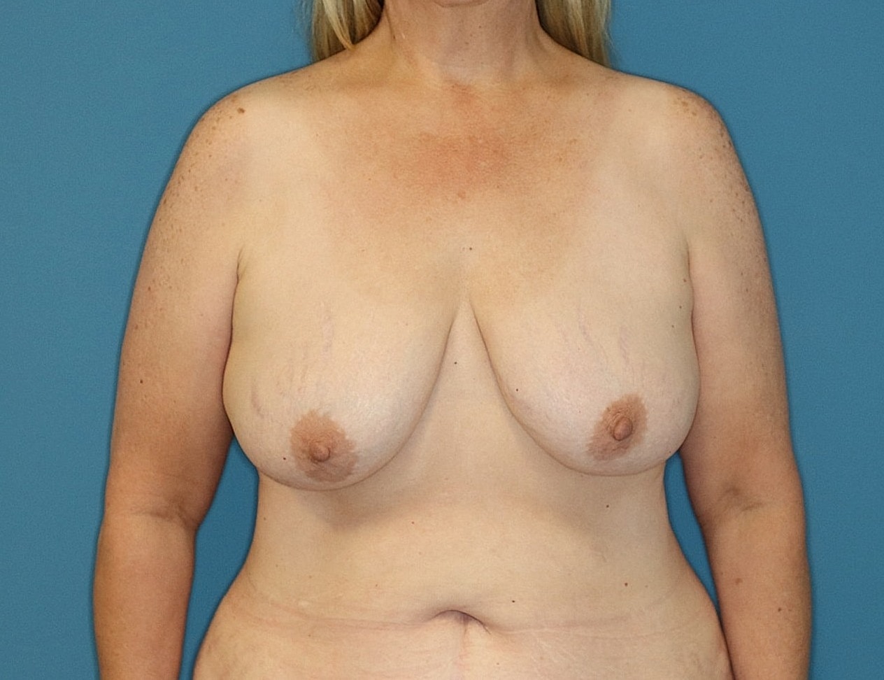 Breast Lift With Fat Transfer Before & After