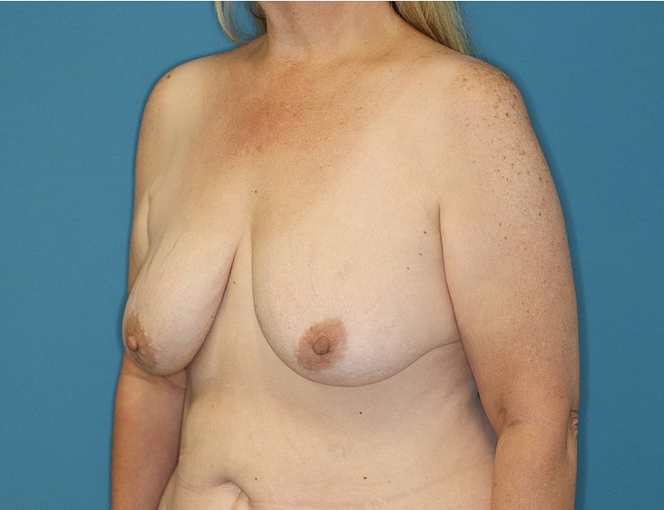 Breast Lift With Fat Transfer Before & After