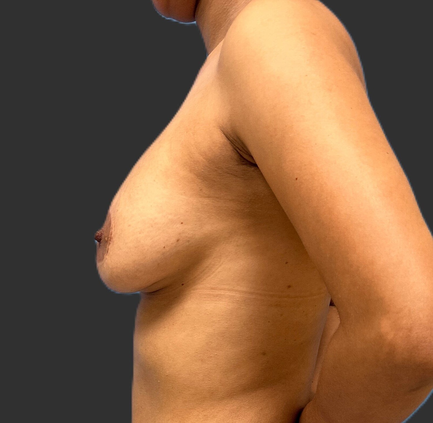Breast Lift With Augmentation Revision Before & After