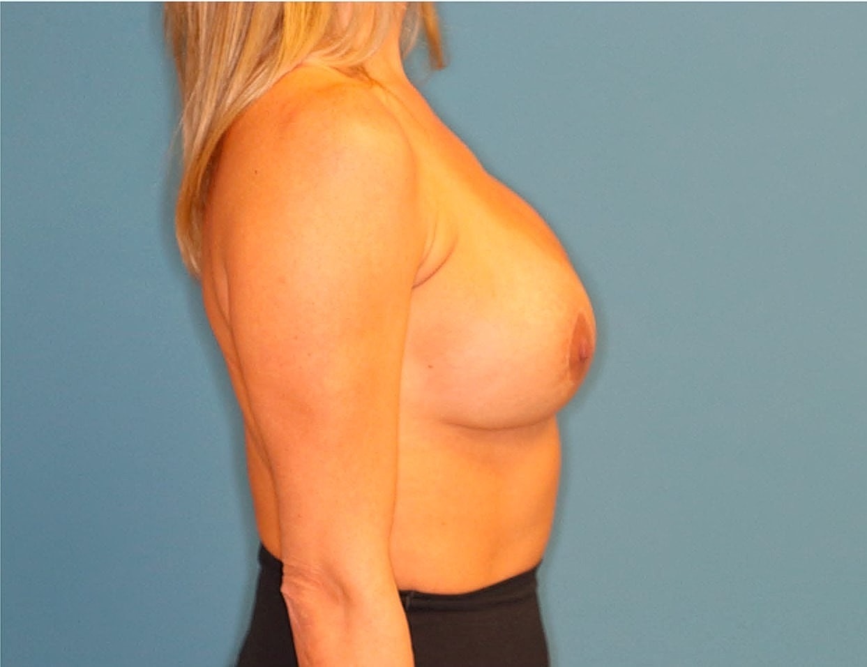 Breast Lift With Augmentation Revision Before & After