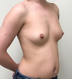 Breast Augmentation Before & After