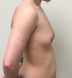 Breast Augmentation Before & After