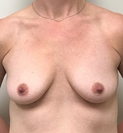 Breast Augmentation Before & After