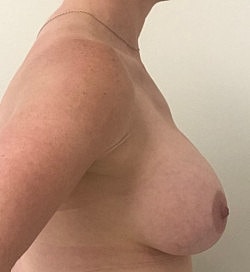 Breast Augmentation Before & After