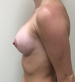 Breast Augmentation Before & After