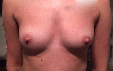 Breast Augmentation Before & After