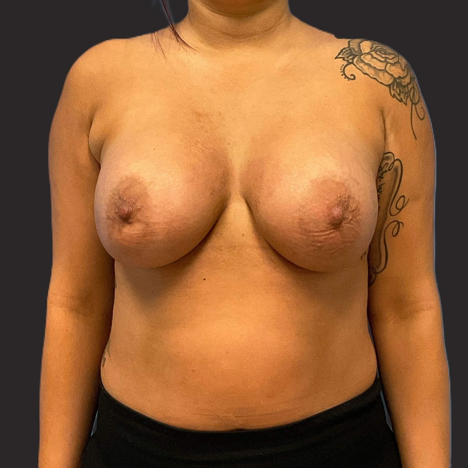 Breast Augmentation Before & After