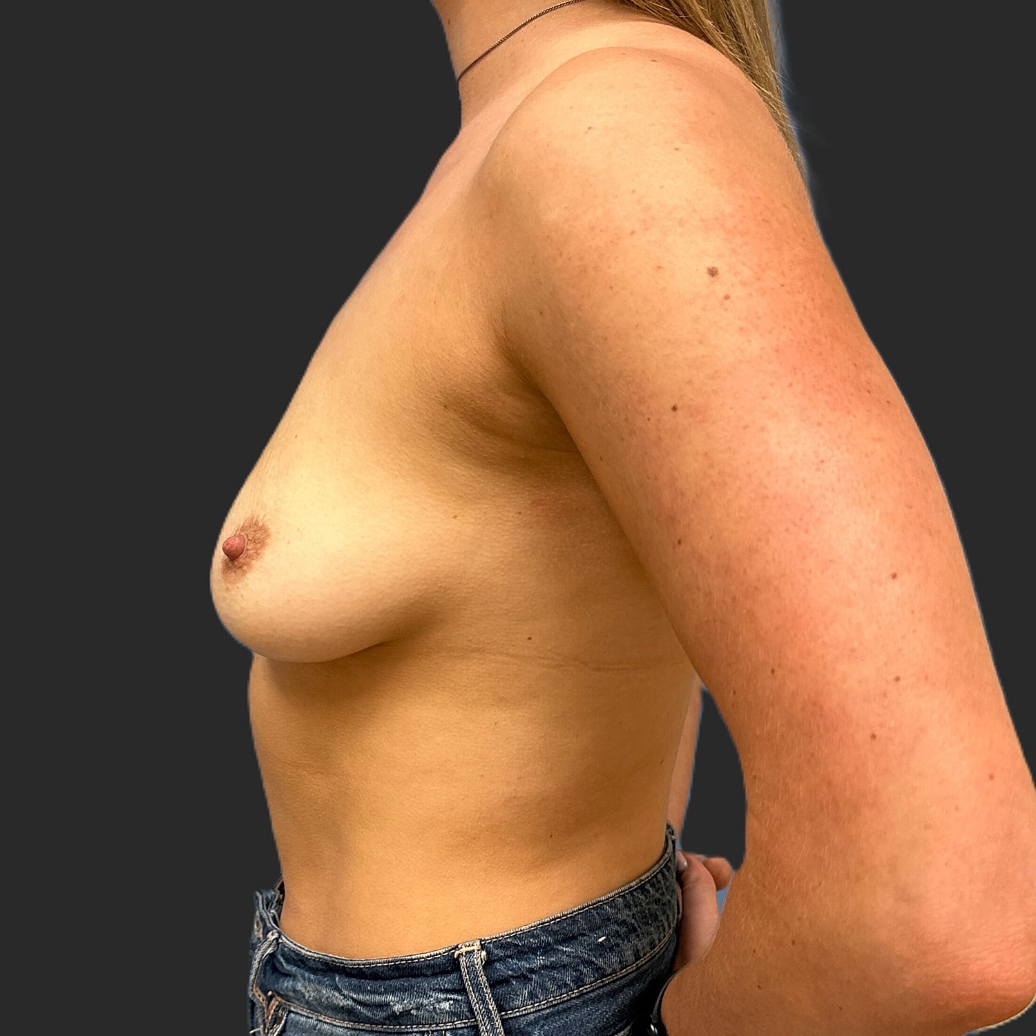 Breast Augmentation Before & After