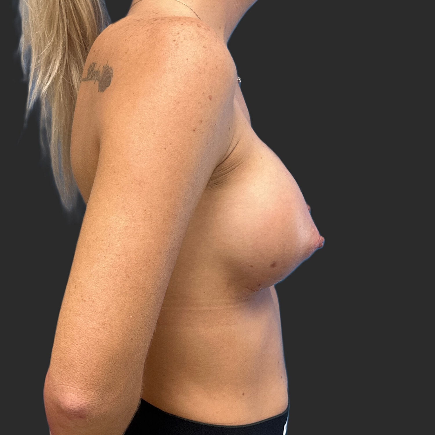 Breast Augmentation Before & After