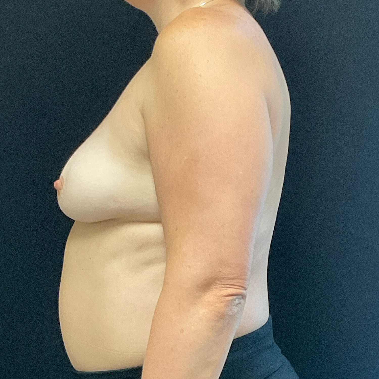 Breast Augmentation Before & After